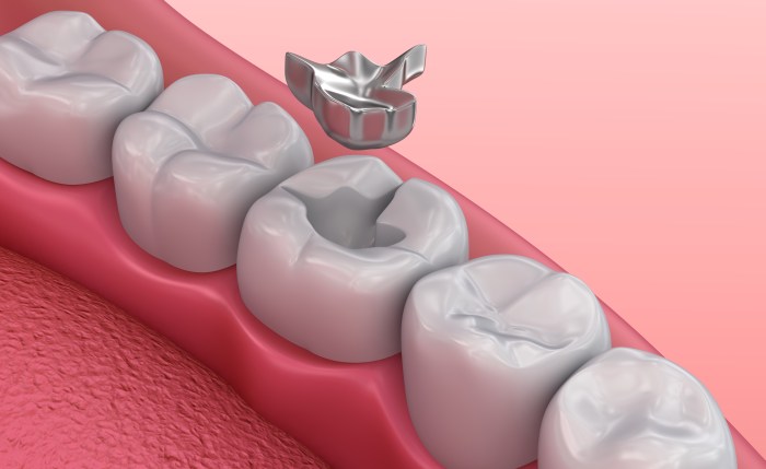 Amalgam filling tooth fillings cavities dental waste cavity under decay fill dentist lead